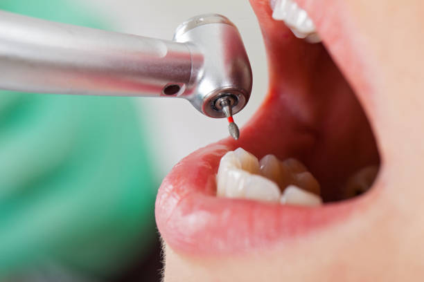 Best Emergency Dentist for Lost Fillings or Crowns in Del Rey, CA